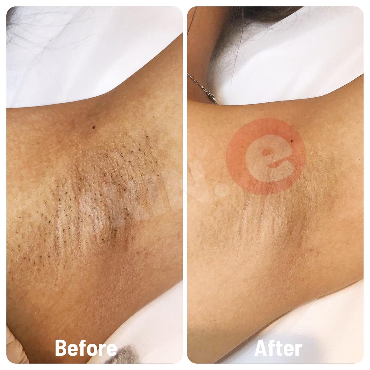 Hairerazer + Brightlite